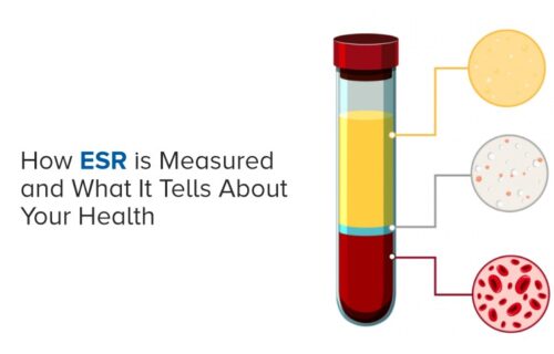 Introduction to Erythrocyte Sedimentation Rate (ESR)